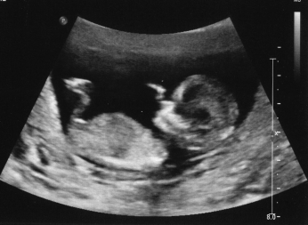 ultrasound12weeks.jpg